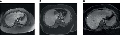 Case Report: Hepatic Adenomatosis in a Patient With Prader–Willi Syndrome